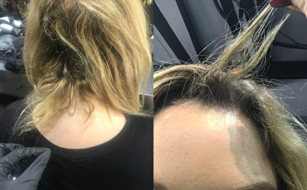 hair loss